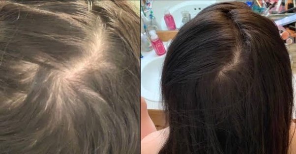 Can Rosemary Oil for hair growth Treat Hair Loss