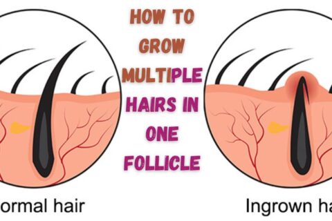 Multiple Hairs in One Follicle
