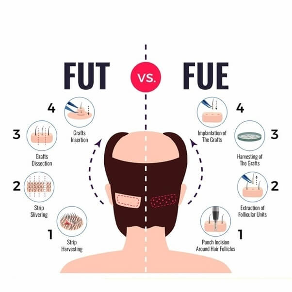 hair transplant cost and types