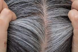causes of gray hairs