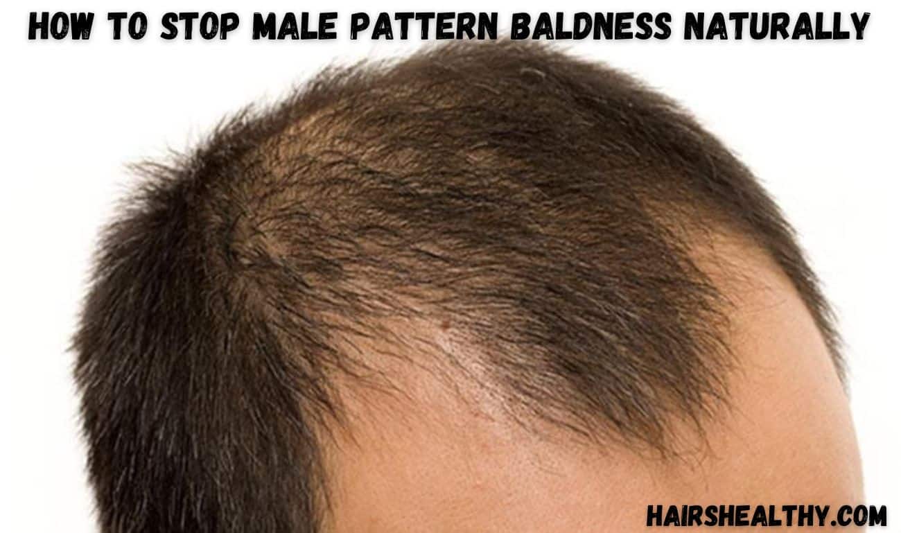How to Stop Male Pattern Baldness Naturally