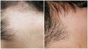 MSM for Hair Growth